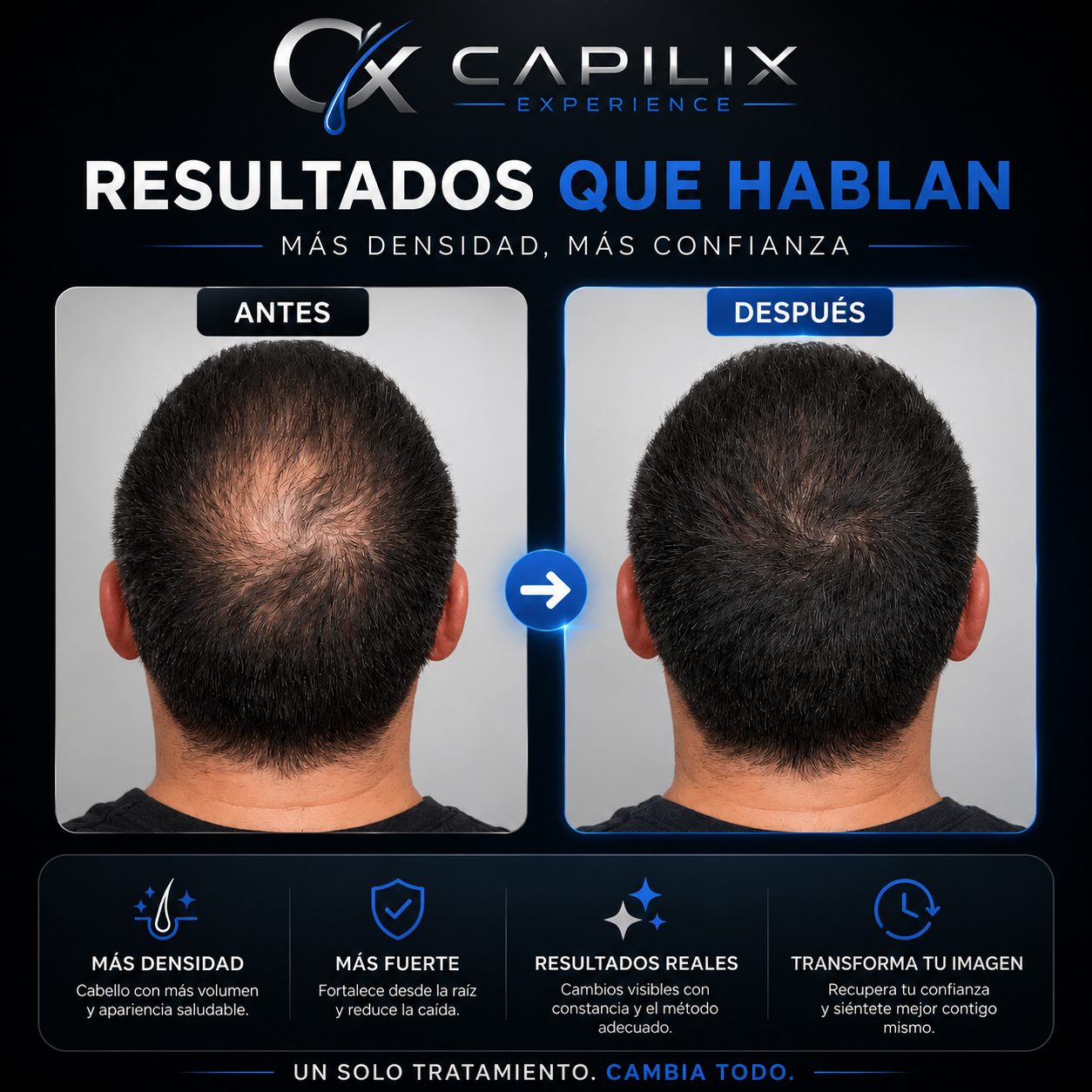 Capilix Experience™ — Tratamiento Personalizado Anticaída