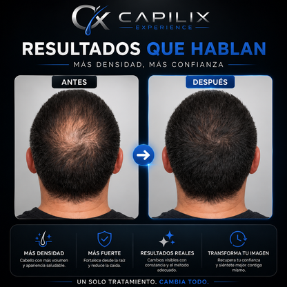 Capilix Experience™ — Tratamiento Personalizado Anticaída