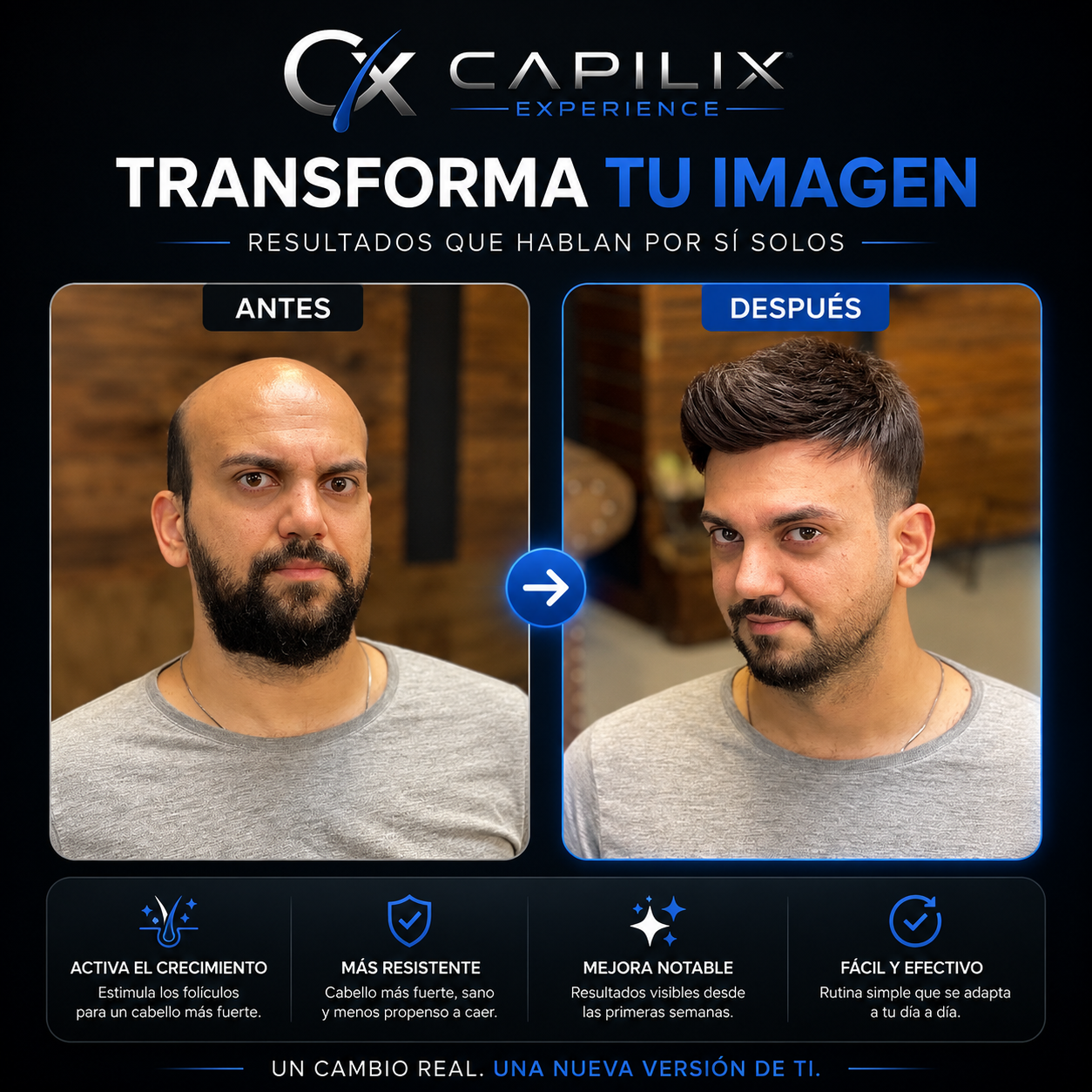Capilix Experience™ — Tratamiento Personalizado Anticaída